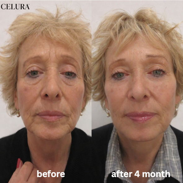 Celura Micro Infusion System