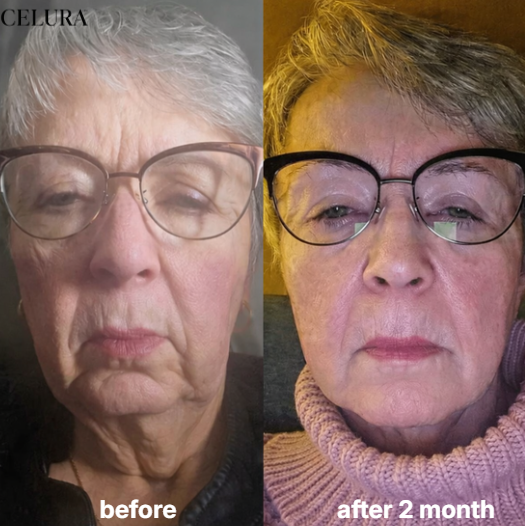 Celura Micro Infusion System