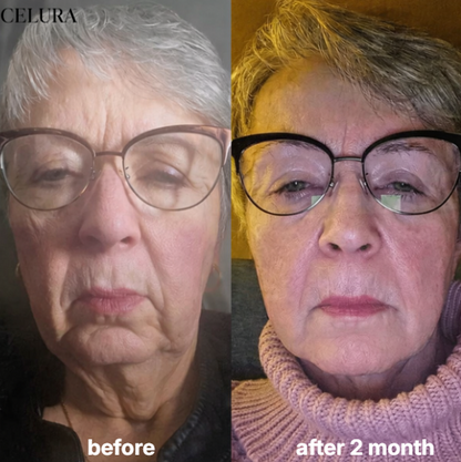 Celura Micro Infusion System