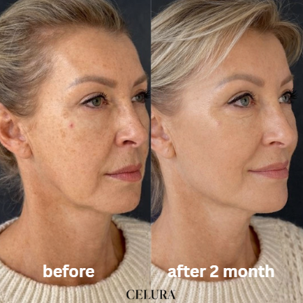 Celura Micro Infusion System